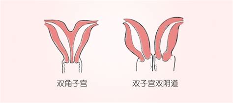 子宫畸形:纵膈子宫、双角子宫和双子宫的治疗策略-新闻动态- 上海红睦房中城医院